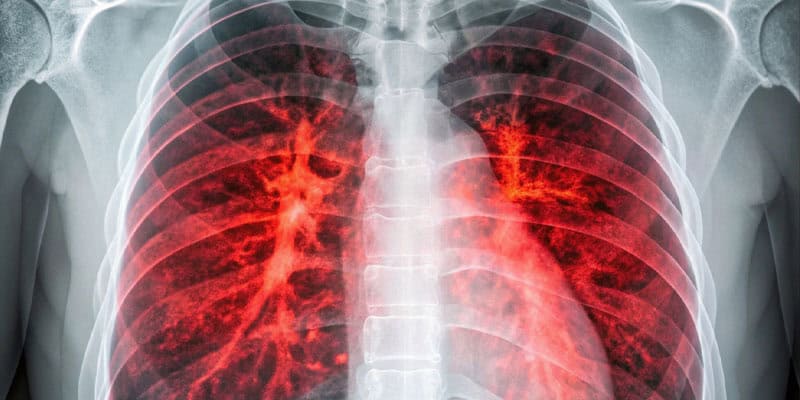 What Are the 4 Stages of COPD