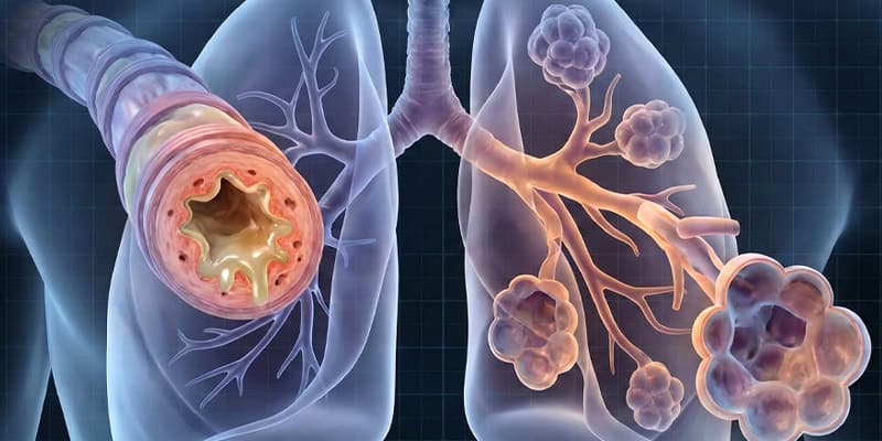 Is COPD Contagious or Genetic